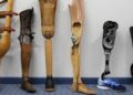 The Ago Care Foundation to Distribute 300 Free Artificial Limbs to Amputees in Anambra