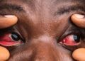 UGANDA FACES OUTBREAK OF CONJUNCTIVITIS