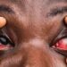 UGANDA FACES OUTBREAK OF CONJUNCTIVITIS