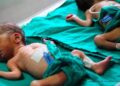 UN REPORT SAYS GLOBAL CHILD DEATHS DROPPED TO 4.9M IN 2022
