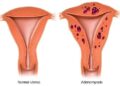 WHAT WOMEN WITH ADENOMYOSIS SHOULD KNOW AS GYNAECOLOGISTS SEEK IMPROVED AWARENESS