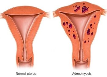 WHAT WOMEN WITH ADENOMYOSIS SHOULD KNOW AS GYNAECOLOGISTS SEEK IMPROVED AWARENESS