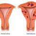 WHAT WOMEN WITH ADENOMYOSIS SHOULD KNOW AS GYNAECOLOGISTS SEEK IMPROVED AWARENESS