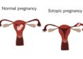 ABUSING FERTILITY DRUGS RAISES RISK OF ECTOPIC PREGNANCY – GYNAECOLOGISTS