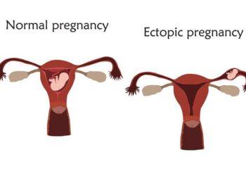 ABUSING FERTILITY DRUGS RAISES RISK OF ECTOPIC PREGNANCY – GYNAECOLOGISTS