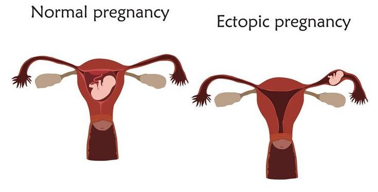 ABUSING FERTILITY DRUGS RAISES RISK OF ECTOPIC PREGNANCY – GYNAECOLOGISTS