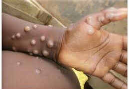 DR CONGO: INFECTIOUS DISEASE EXPERTS COORDINATE EFFORTS AGAINST MONKEY POX