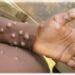 DR CONGO: INFECTIOUS DISEASE EXPERTS COORDINATE EFFORTS AGAINST MONKEY POX