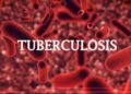 TUBERCULOSIS KILLS 1,869 IN KWARA, 7,496 CASES RECORDED IN ENUGU, BORNO