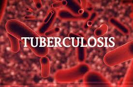 TUBERCULOSIS KILLS 1,869 IN KWARA, 7,496 CASES RECORDED IN ENUGU, BORNO