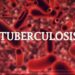 TUBERCULOSIS KILLS 1,869 IN KWARA, 7,496 CASES RECORDED IN ENUGU, BORNO