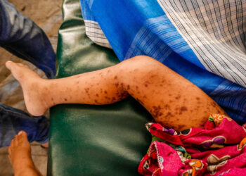 19 CHILDREN KILLED BY MEASLES COMPLICATIONS IN ADAMAWA STATE