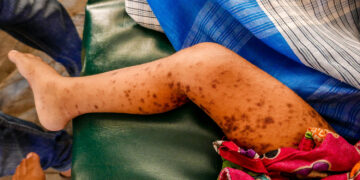 19 CHILDREN KILLED BY MEASLES COMPLICATIONS IN ADAMAWA STATE