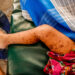 19 CHILDREN KILLED BY MEASLES COMPLICATIONS IN ADAMAWA STATE
