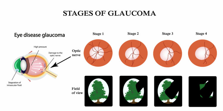 HOW GLAUCOMA, RETINAL DISEASE CAUSES IRREVERSIBLE BLINDNESS – OPHTHALMOLOGISTS