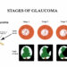 HOW GLAUCOMA, RETINAL DISEASE CAUSES IRREVERSIBLE BLINDNESS – OPHTHALMOLOGISTS