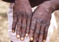 SOUTH AFRICA RECORDS FIRST MONKEY POX DEATH