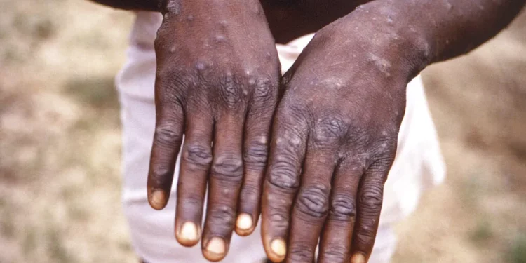 SOUTH AFRICA RECORDS FIRST MONKEY POX DEATH