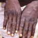 SOUTH AFRICA RECORDS FIRST MONKEY POX DEATH