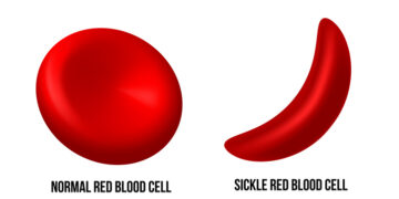 HEALTH ADVOCATE DECRIES DISCRIMINATION, EXCLUSION OF SICKLE CELL PATIENTS