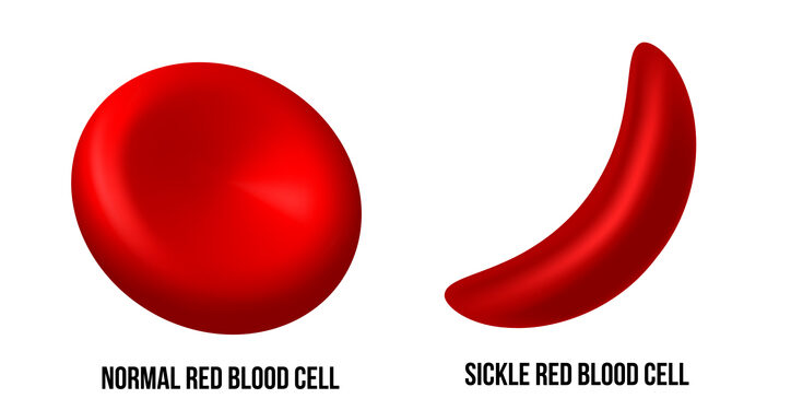 HEALTH ADVOCATE DECRIES DISCRIMINATION, EXCLUSION OF SICKLE CELL PATIENTS