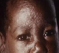 SUSPECTED MEASLES OUTBREAK KILLS 10 CHILDREN IN ABUJA.