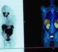NEW HOPE FOR PROSTATE CANCER PATIENTS WITH DRUG TRIAL