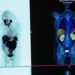 NEW HOPE FOR PROSTATE CANCER PATIENTS WITH DRUG TRIAL