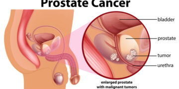 SCIENTISTS ADVOCATE HOLISTIC APPROACH TO PROSTATE DISORDERS PREVENTION.