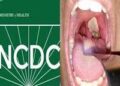 NCDC CONFIRMS 7,784 DIPHTHERIA CASES IN 170 LGAs IN NIGERIA.