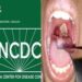 NCDC CONFIRMS 7,784 DIPHTHERIA CASES IN 170 LGAs IN NIGERIA.