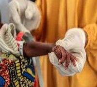 WHY ONE IN FOUR CHILDREN IN TWO ZAMFARA STATE LGAS MALNOURISHED – MSF