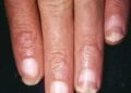 LONG FINGERNAILS HARBOUR 32 PARASITES, DOCTORS WARN.