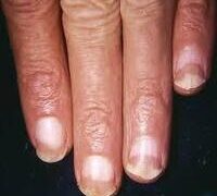 LONG FINGERNAILS HARBOUR 32 PARASITES, DOCTORS WARN.