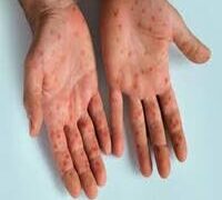 MPOX CASES RISE TO102 IN 25 STATES, FCT OF NIGERIA.