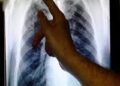 8.2 MILLION DIAGNOSED WITH TB IN 2023, SAYS WHO.