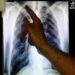 8.2 MILLION DIAGNOSED WITH TB IN 2023, SAYS WHO.