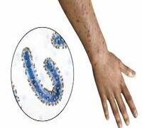 OUTBREAK OF MARBURG VIRUS DISEASE IN TANZANIA PUT MOZAMBIQUE ON ALERT.