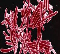 TUBERCULOSIS KILLED 1.23 MILLION GLOBALLY IN 2024 -WHO.