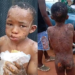 10-YEAR-OLD ASSAULT VICTIM RECEIVING TREATMENT -ANAMBRA COMMISSIONER.